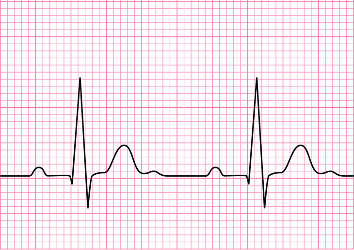 ECG