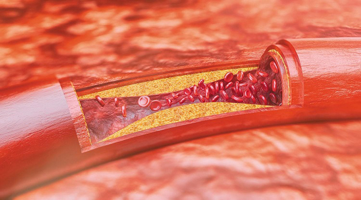 Làm giảm cholesterol trong máu và giảm xơ cứng động mạch