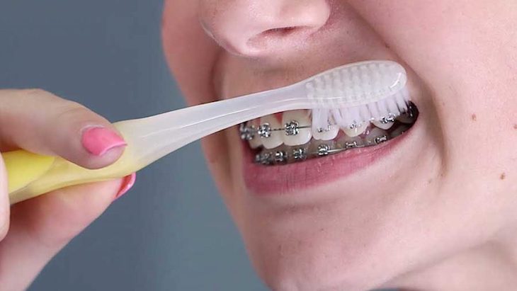 Mắc cài và dây cung làm hạn chế hiệu quả của việc vệ sinh răng miệng